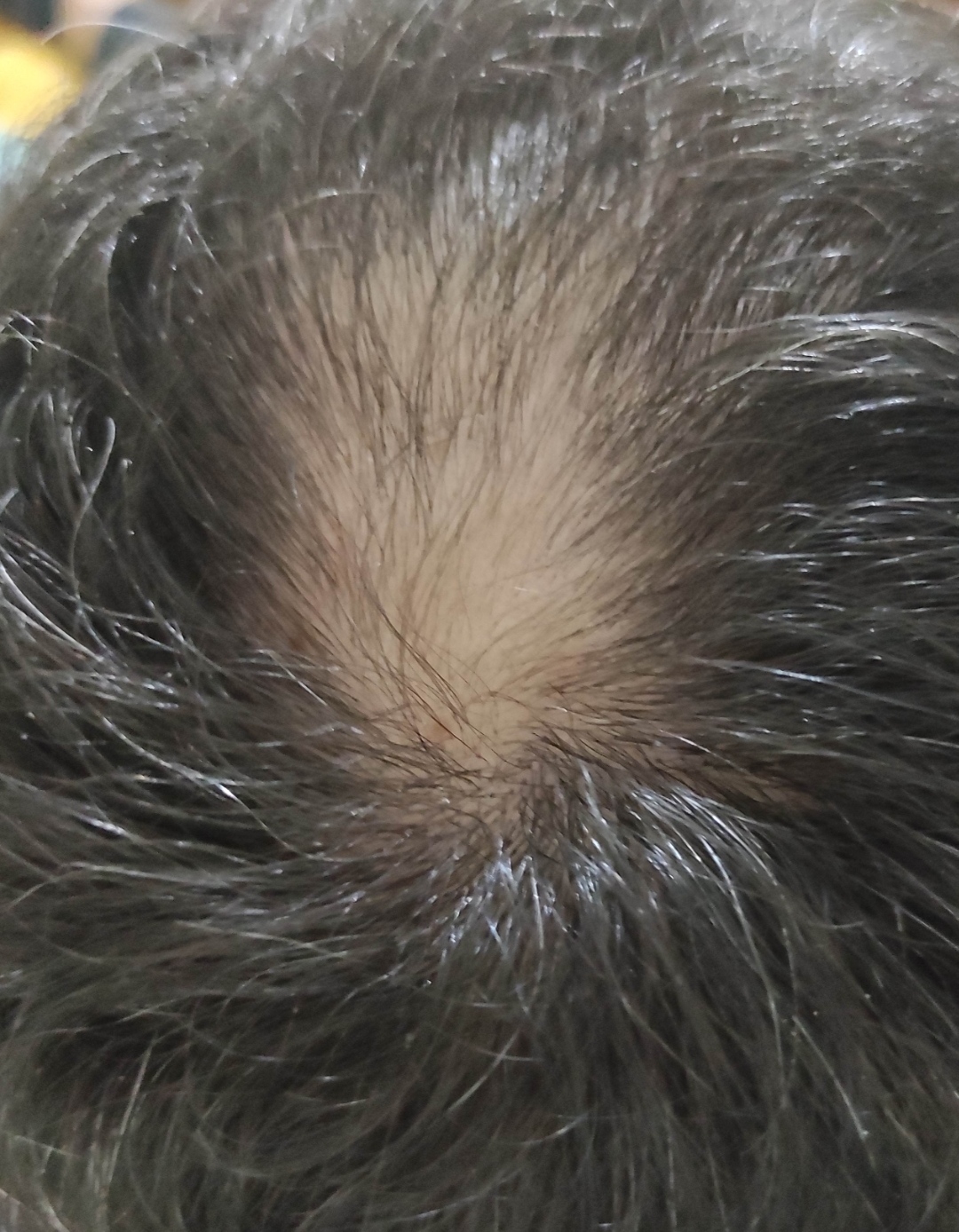 Yanlardan açılan saçlar için çözüm - Saç Tedavisi Forum Saçların Yanlardan Açılması Nasıl Engellenir?