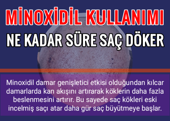  Minoxil ne kadar süre saç döker?