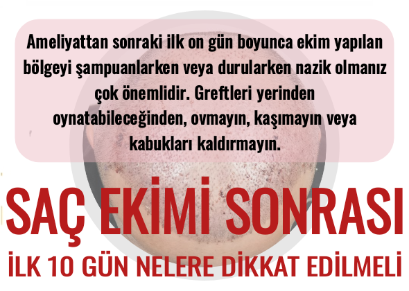 Saç Ekimi Sonrası İlk 10 Gün Nelere Dikkat Edilmeli?
