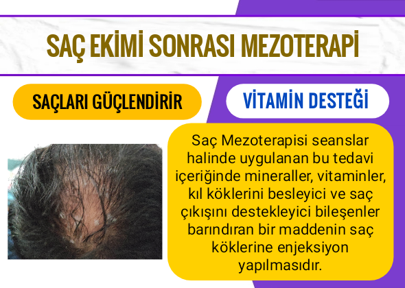 Saç Ekimi Sonrası Mezoterapi Ne Zaman Yapılır?