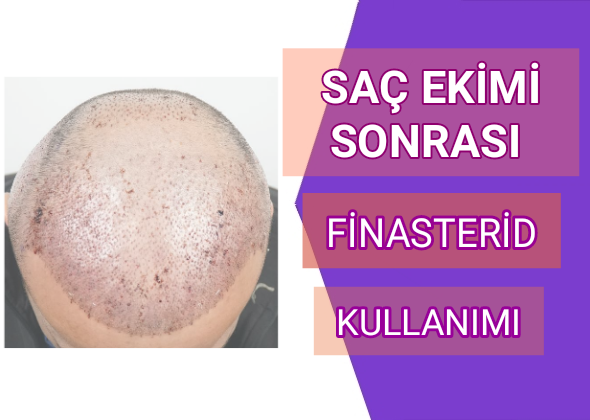 Proscar Saç Ekimi Sonrası Kullanımı