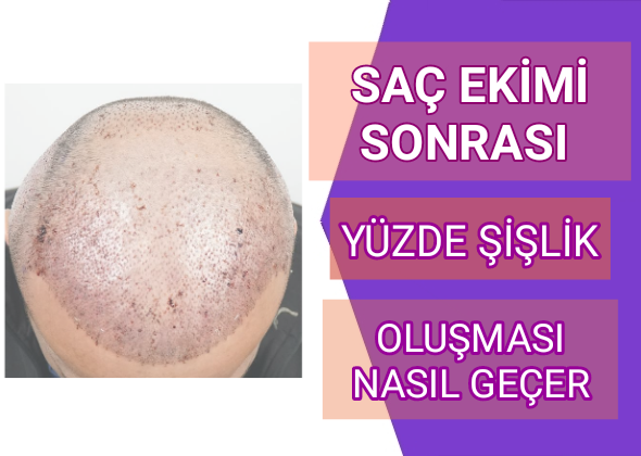 Saç Ekimi Sonrası Yüzde Şişlik Oluşması Nasıl Geçer?