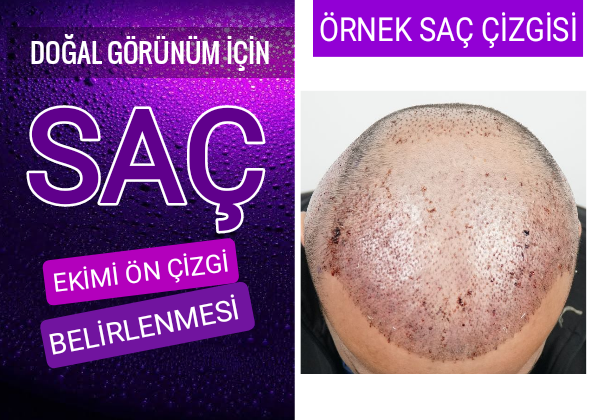 Saç Ekiminde Ön Çizgi Nasıl Belirlenir?